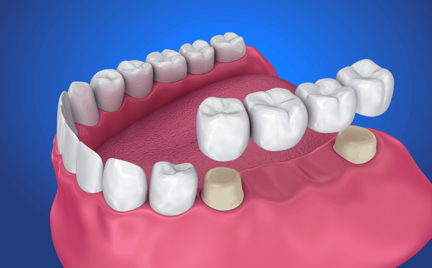 How To Prolong The Life Of Your Dental Bridge Prairie Pines Dental Centre   Life Of Your Dental Bridge 1452x900 