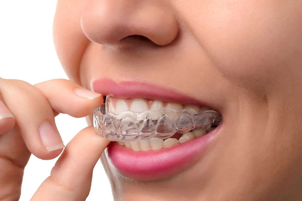 Advantages and Disadvantages of Invisible Aligners