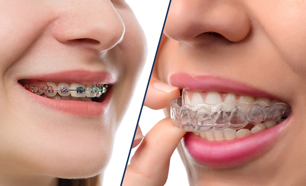 Invisalign Braces, Invisalign Clear Aligners & Treatment, Mississauga - Dr.  Pinto