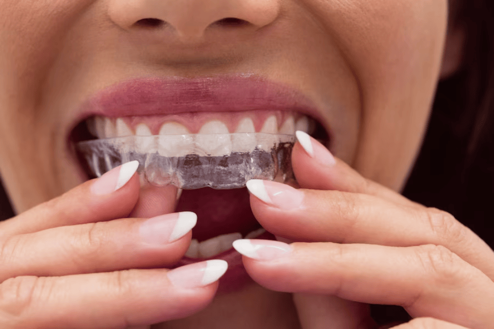 maintaining oral hygiene with invisalign aligners